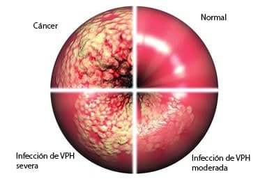 Importancia de la prueba Papanicolau