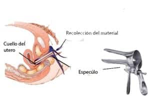 Como se realiza el Papanicolau