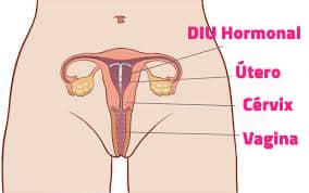 Colocación del DIU Hormonal